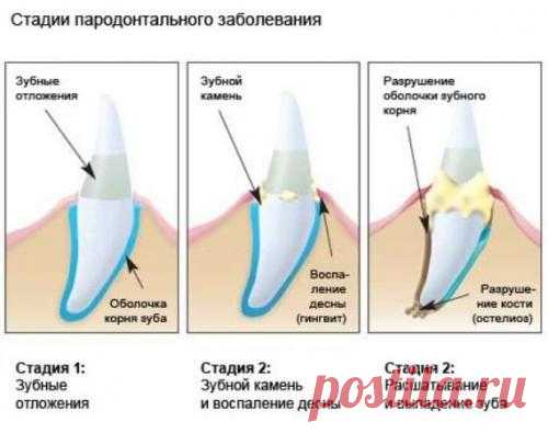 Рецепты народной медицины при пародонтозе и кровотечении десен
