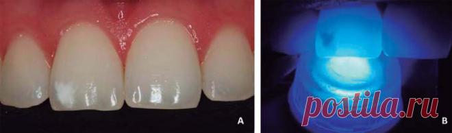 Что намазать на зубы, чтобы они не выпали / Geektimes
