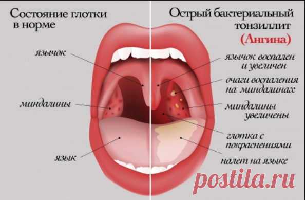 Летняя ангина: как быстро вылечиться в жару без антибиотиков и восстановиться. Эффективно и безвредно