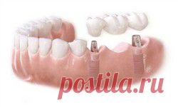 Мостовидные протезы и имплантаты. Одесса - все об имплантах от А до Я