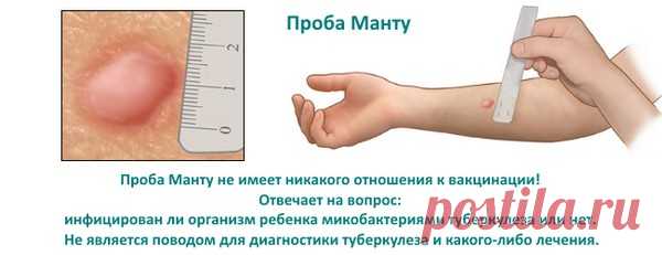Реакция на пробу Манту: норма у детей и взрослых(***)