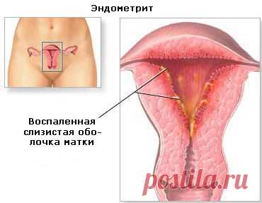 Лечим дома:эндометрит