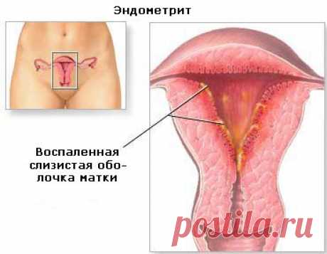 Лечим дома:эндометрит