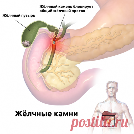 Китайский способ избавиться от всех желчных камней за неделю.