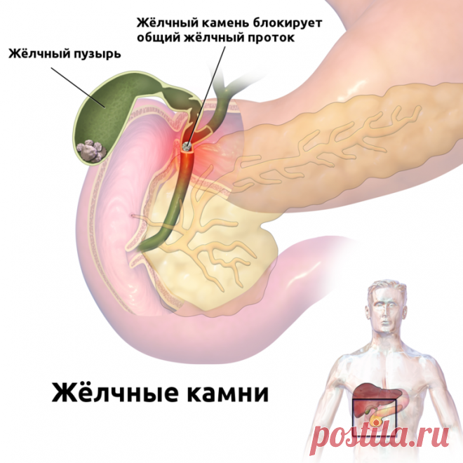 Китайский способ избавиться от всех желчных камней за неделю.