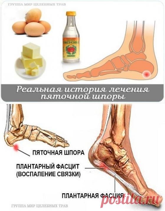 Фасциит подошвенного апоневроза. Как лечить шпоры на пятке. Как лечить шпоры на ногах у женщин. Как лечить шпоры на ногах у женщин. Как лечить шпоры на ногах у женщин.