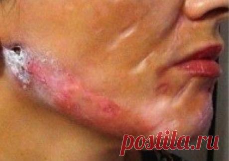 Болезнь Моргеллонов: реальность или миф? | vita-jizn.net
Болезнь Моргеллонов вызывает содрогание и ужас. Впервые болезнь Моргеллонов описали в  XVII веке во Франции. Первыми заболели дети Моргеллон в Лангедоке.
Профессор Михаил Андрейчин впервые в Украине начал изучать это заболевание на своей кафедре в Тернопольском медицинском университете.
руппа ученых-медиков получила патент на диагностирование болезни Моргеллонов.
https://vita-jizn.net/sdorovje/bolezn-morgellonov