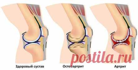 Употребляя это средство, вы забудете про боль в суставах и коленях!
