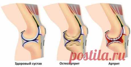 Употребляя это средство, вы забудете про боль в суставах и коленях!