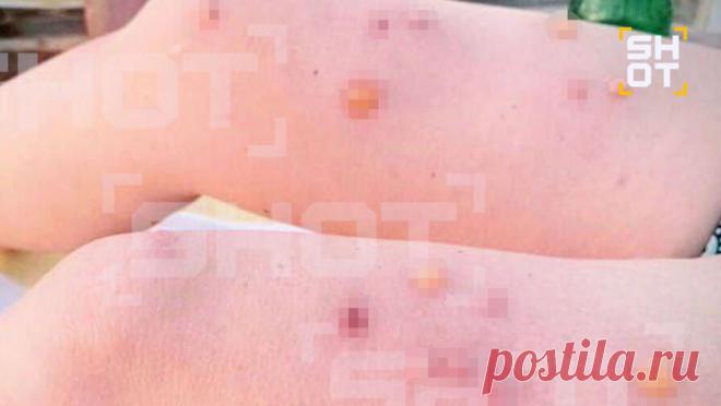 Российские туристы пожаловались на тигровых комаров в Индии. Тигровые комары, переносящие денге, чикунгунью и другие лихорадки, не дают покоя туристам на Гоа. Об этом сообщил Life со ссылкой на Telegram-канал SHOT. "Россияне жалуются на волдыри после укусов, многим требовалась помощь ...