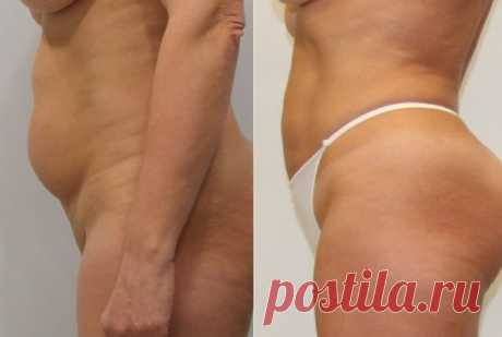 Мой лучший результат за 4 недели: Убрала жир с живота копеечным аптечным средством для обёртывания! | Худеем Дома | Яндекс Дзен