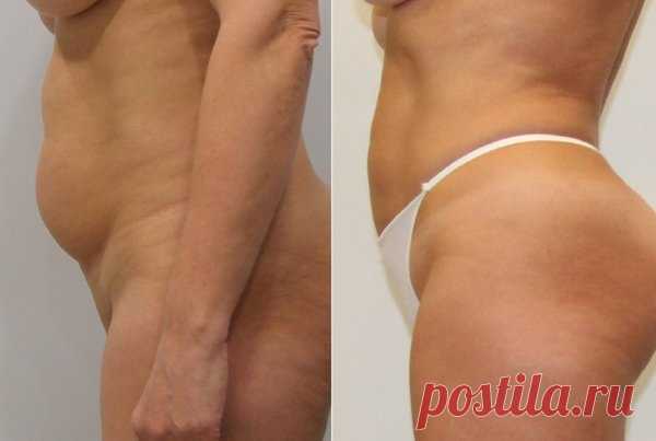 Мой лучший результат за 4 недели: Убрала жир с живота копеечным аптечным средством для обёртывания! | Худеем Дома | Яндекс Дзен