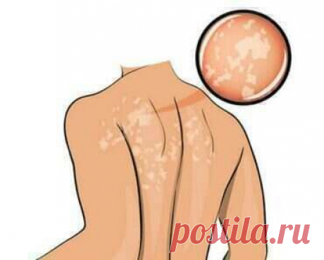 Дефицит витамина B12: симптомы и болезни, которые он провоцирует! — Турба-Урба