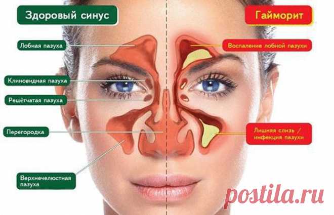5 природных средств для защиты от синусита Причины хронического синусита могут быть разные: чрезмерное потребление молочных продуктов (сыр, молоко, мороженое, йогурты и т.д.) аллергия на окружающую среду