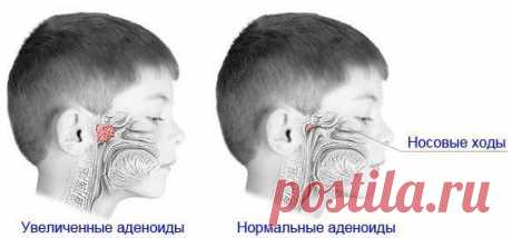 Как вылечить аденоиды без операции - В здоровом теле — здоровый дух