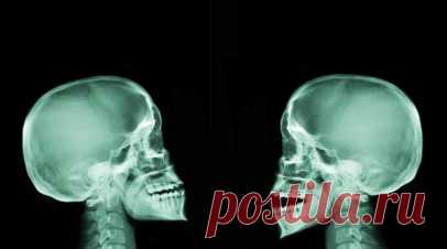 Генетик Кузнецова: ключично-черепной дизостоз считается наследственным. Врач-генетик Кристина Кузнецова рассказала, что ключично-черепной дизостоз считается наследственным заболеванием. Читать далее