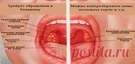 Опять заболело горло что делать - Сами Доктора