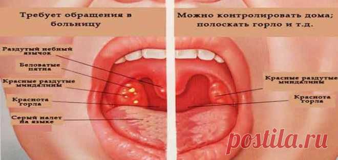 Опять заболело горло что делать - Сами Доктора