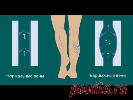 Йога при варикозном расширении вен