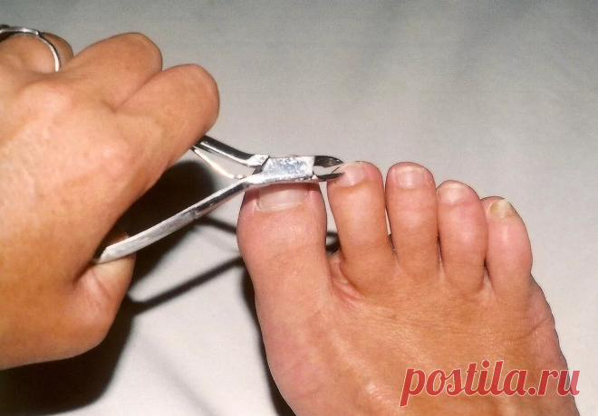 Простые способы остричь жесткие и утолщенные ногти на ногах. 5 советов наших читателей | Ларец здоровья | Яндекс Дзен