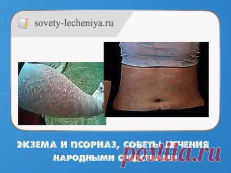Экзема и псориаз, советы лечения народными средствами.