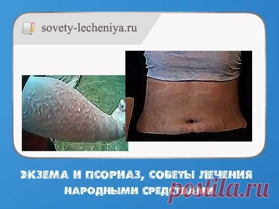 Экзема и псориаз, советы лечения народными средствами.