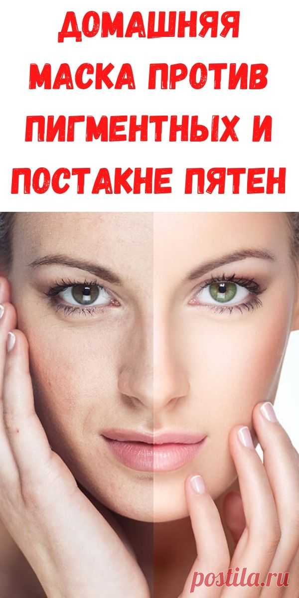 Домашняя маска против пигментных и постакне пятен - Рецепты для женщин Представляем вам удивительное домашнее средство, которое прекрасно удаляет темные пятна на лице, отбеливая кожу, придавая ей ровный, натуральный оттенок.Это почти магический трюк, который помогает сохранять нам нашу кожу без пятен и сделать ее более мягкой и гладкой. Домашняя косметика — это то, что помогает оставаться нам красивыми и при этом экономить кучу денег. Сегодня мы расскажем вам, как […]