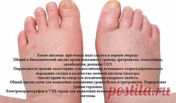Отекают ноги – Причины и лечение – как снять отек ног народными средствами