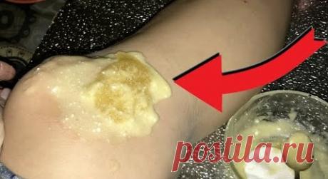 БОЛЯТ КОЛЕНИ И СУСТАВЫ? БОЛЬ УЙДЁТ, ЕСЛИ ПРИЛОЖИТЬ ЭТОТ КОМПРЕСС