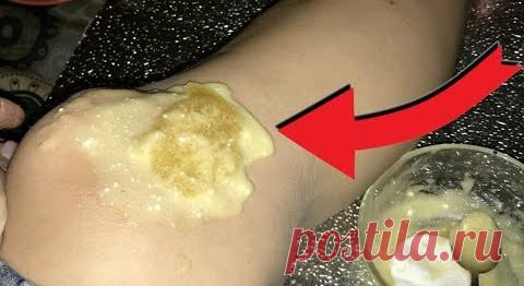 БОЛЯТ КОЛЕНИ И СУСТАВЫ? БОЛЬ УЙДЁТ, ЕСЛИ ПРИЛОЖИТЬ ЭТОТ КОМПРЕСС