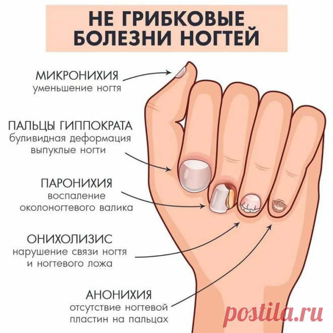 Посмотрите на свои ногти: вот что можно по их изменениям сказать о вашем здоровье | О здоровье: с медицинского на русский | Дзен