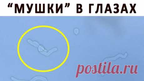 Откуда берутся «мушки» перед глазами? – В РИТМІ ЖИТТЯ