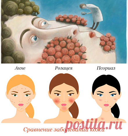 Диета при розацеа: что можно и нельзя употреблять