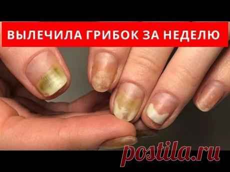 Очень простой и доступный совет как вылечить грибок за 1 неделю