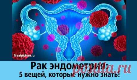 Рак эндометрия: 5 вещей, которые нужно знать! Рак эндометрия: 5 вещей, которые нужно знать!Часто встречается у женщин в период менопаузы и после нее, хотя это может случиться и у тех