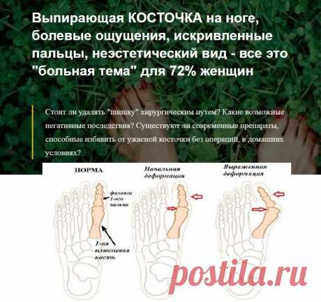Выпирающая КОСТОЧКА на ноге, болевые ощущения, искривленные пальцы, неэстетический вид - все это &quot;больная тема&quot; для 72% женщин
Стоит ли удалять &quot;шишку&quot; хирургическим путем? Какие возможные негативные последствия? Существуют ли современные препараты, способные избавить от ужасной косточки без операций, в домашних условиях? | Выкройки халатов | корова крючком