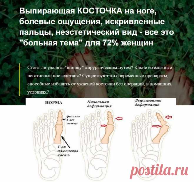 Выпирающая КОСТОЧКА на ноге, болевые ощущения, искривленные пальцы, неэстетический вид - все это "больная тема" для 72% женщин
Стоит ли удалять "шишку" хирургическим путем? Какие возможные негативные последствия? Существуют ли современные препараты, способные избавить от ужасной косточки без операций, в домашних условиях? | Выкройки халатов | корова крючком начинки для тарталеток