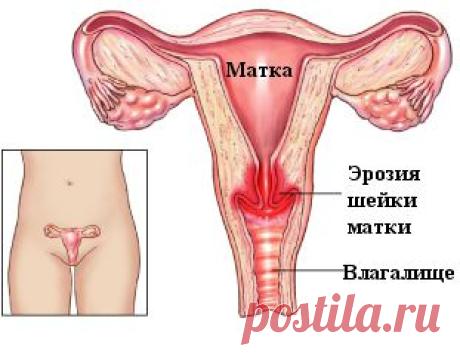 Эрозия шейки матки...??? Лечим...