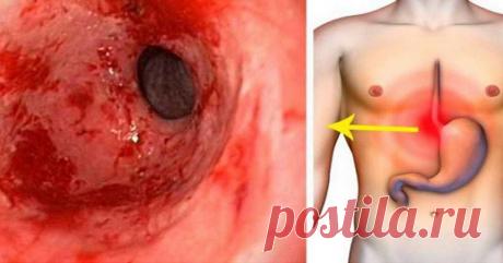 Замучил гастрит и изжога? Мы знаем решение! Всё в нашем видео!
