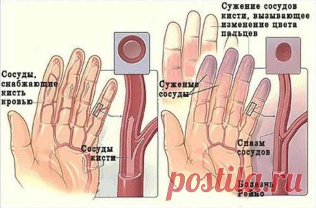 Народные средства против онемения рук и ног: как вылечиться и быть здоровым! Просто, но действенно