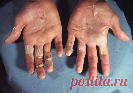 Шелушение кожи на пальцах рук: причины и лечение
Руки у женщин могут рассказать о ее работе, возрасте, нагрузках и всех негативных факторах которые они испытывают в жизни. Необходимо заботиться о здоровом виде кожи на руках. При первых причинах шелушения, категорически нельзя затягивать процесс восстановления мягкости и нежности кожи. Регулярный уход за руками поможет поддерживать здоровый вид и их красоту. Основные причины сухости и […]
Читай пост далее на сайте. Жми ⏫ссылку выше