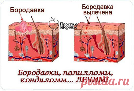 Бородавки