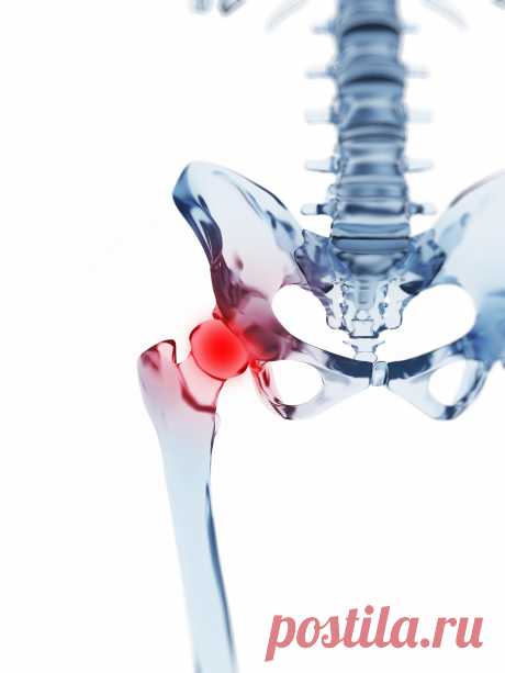 Тазобедренный сустав и его заболевания | Ортопедия Германии