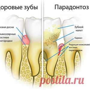 Чем лечить пародонтоз в домашних условиях