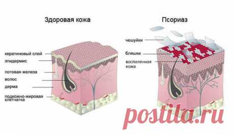 Псориаз — не заболевание кожи!
