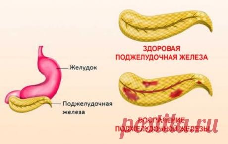Случай излечения воспаления поджелудочной железы при помощи бархатцев и золотого уса | Краше Всех