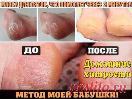 Домашнее СРЕДСТВО ДЛЯ ВАШИХ ПЯТОЧЕК! ПОМОГАЕТ ЗА МИНУТУ!