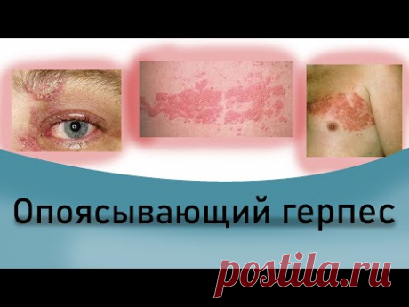 Опоясывающий герпес. Опоясывающий лишай. Симптомы.