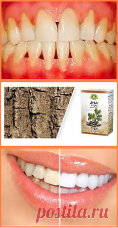 Причины развития и симптомы пародонтоза. Лечение в домашних условиях | Желаемый Образ Жизни