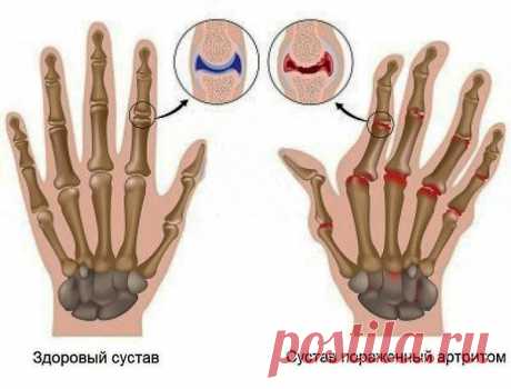 Умный дом/ суставы кистей рук.